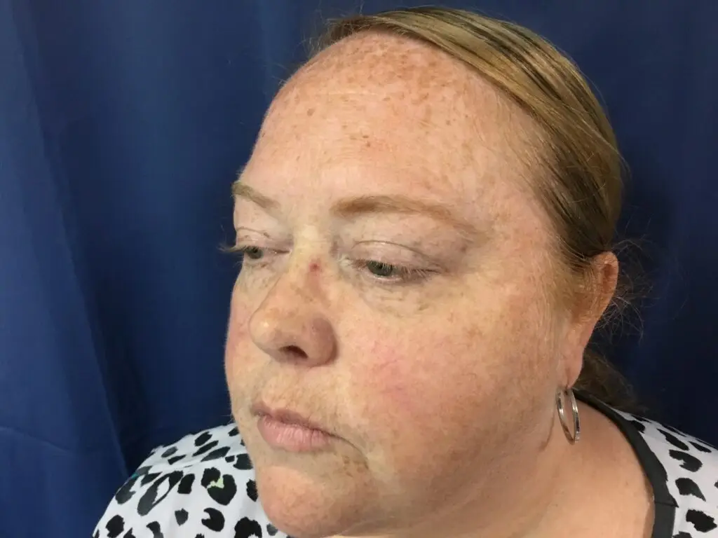 IPL photofacial for sun damage and redness