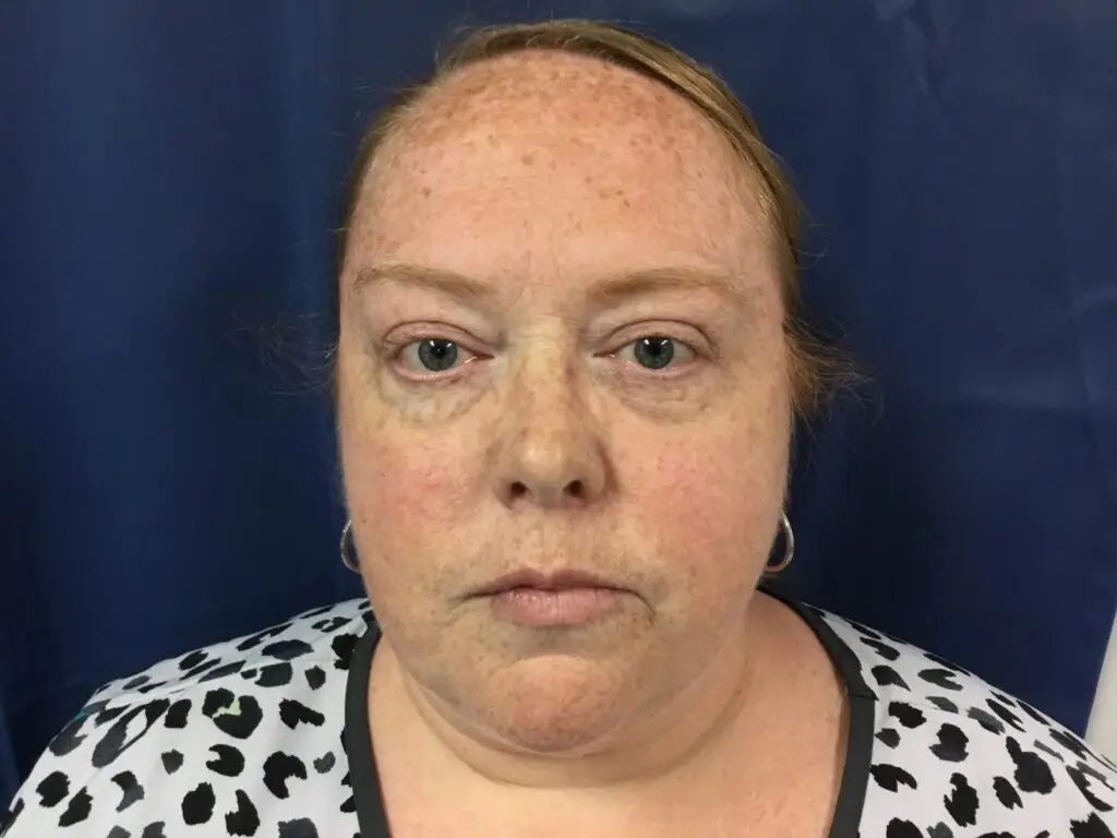 Facial redness before IPL photofacial
