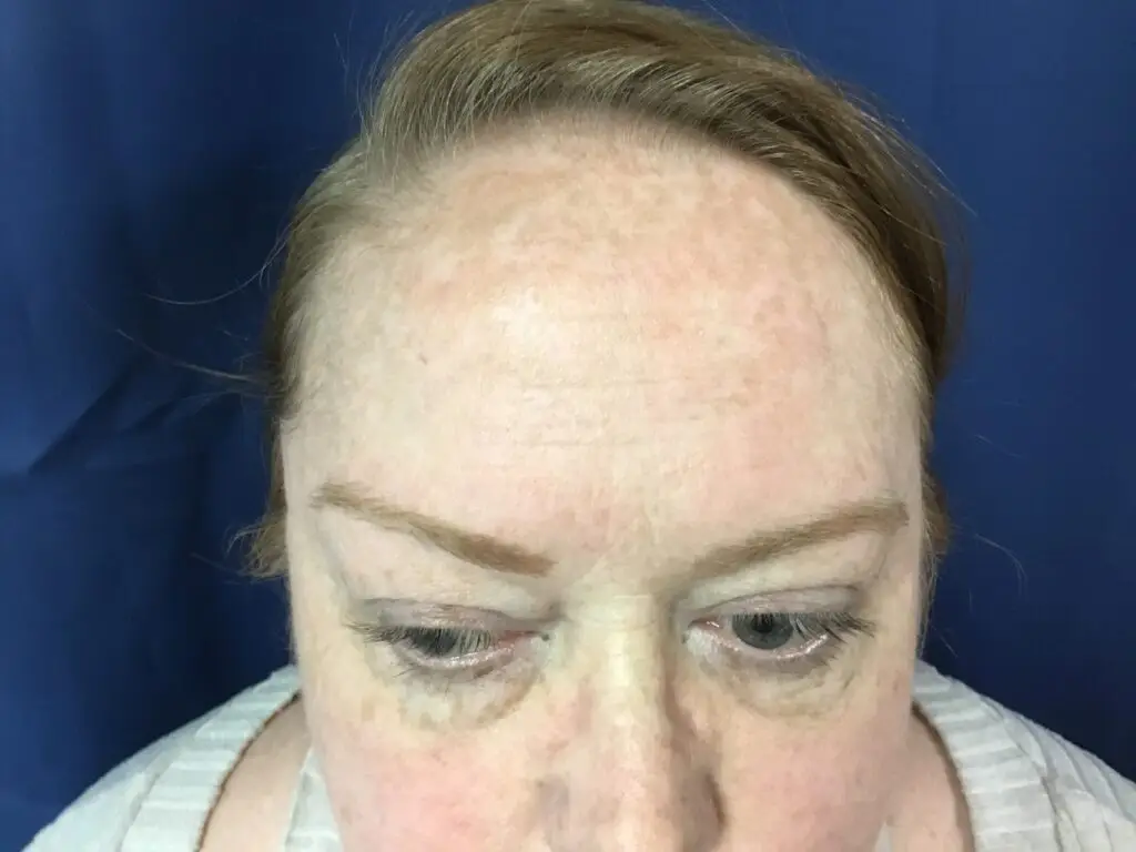 Even skin tone after IPL photofacial