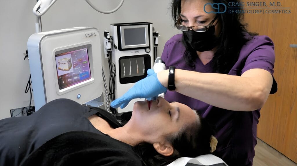 Vivace RF microneedling for skin tightening