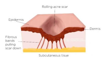 Subcision(R) Step 1