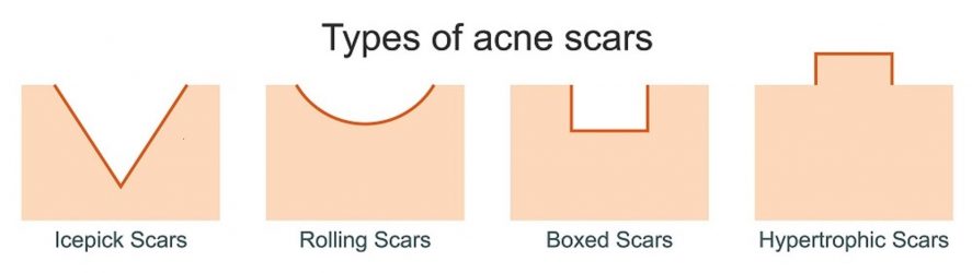 acne-scar-types.jpg