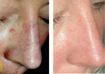KTP Treatment Before and After